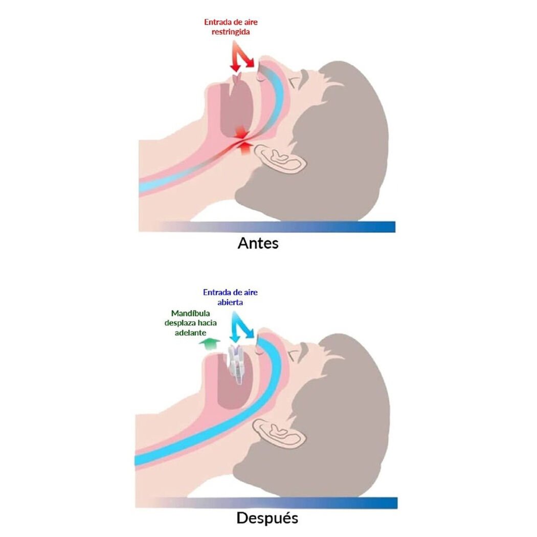 Drimwell Placa Mandibular Antironquido, , large image number 2